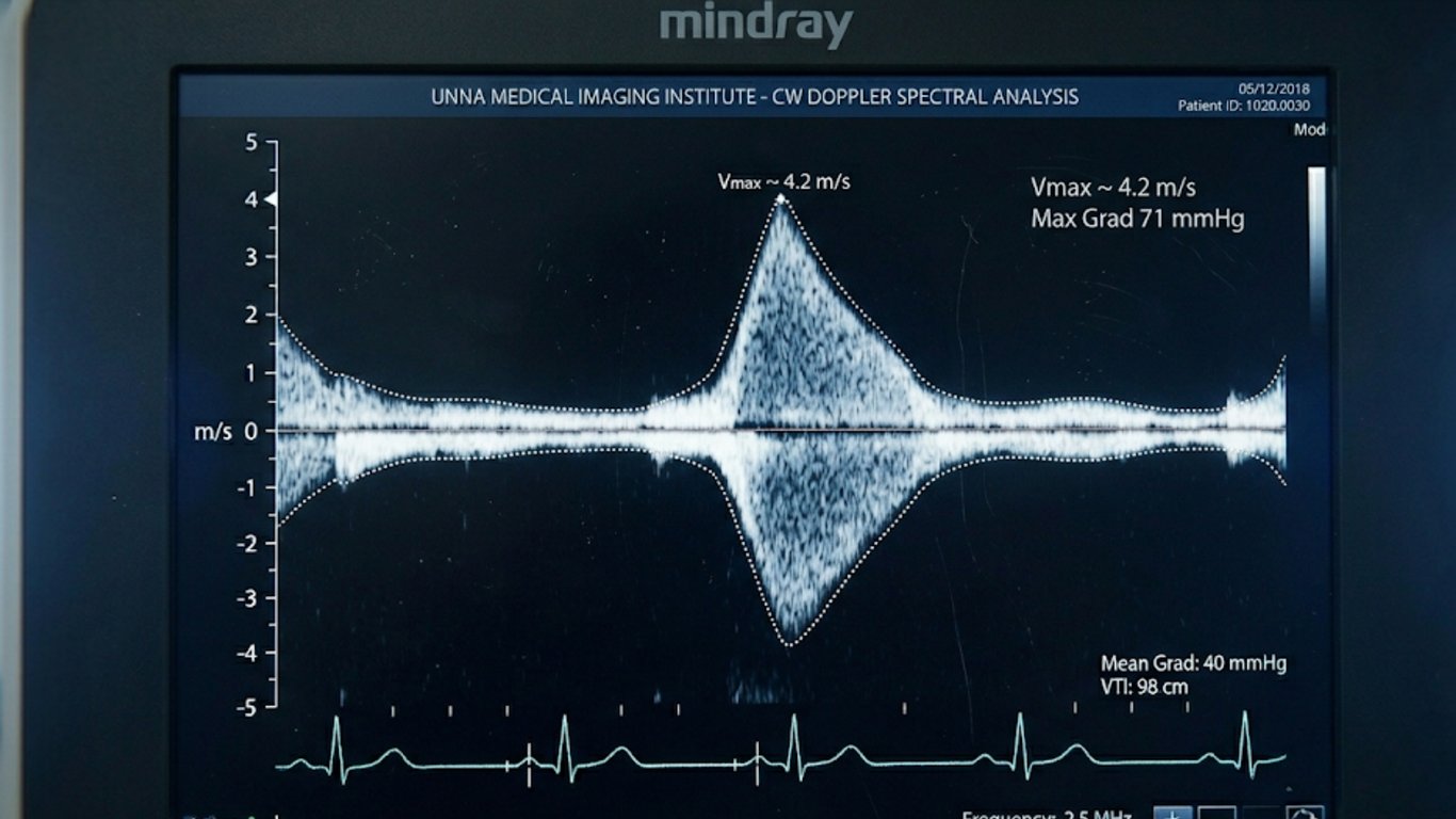 Schilddrüsen-Sonographie — echoarmer Knoten im Längsschnitt der Schilddrüse